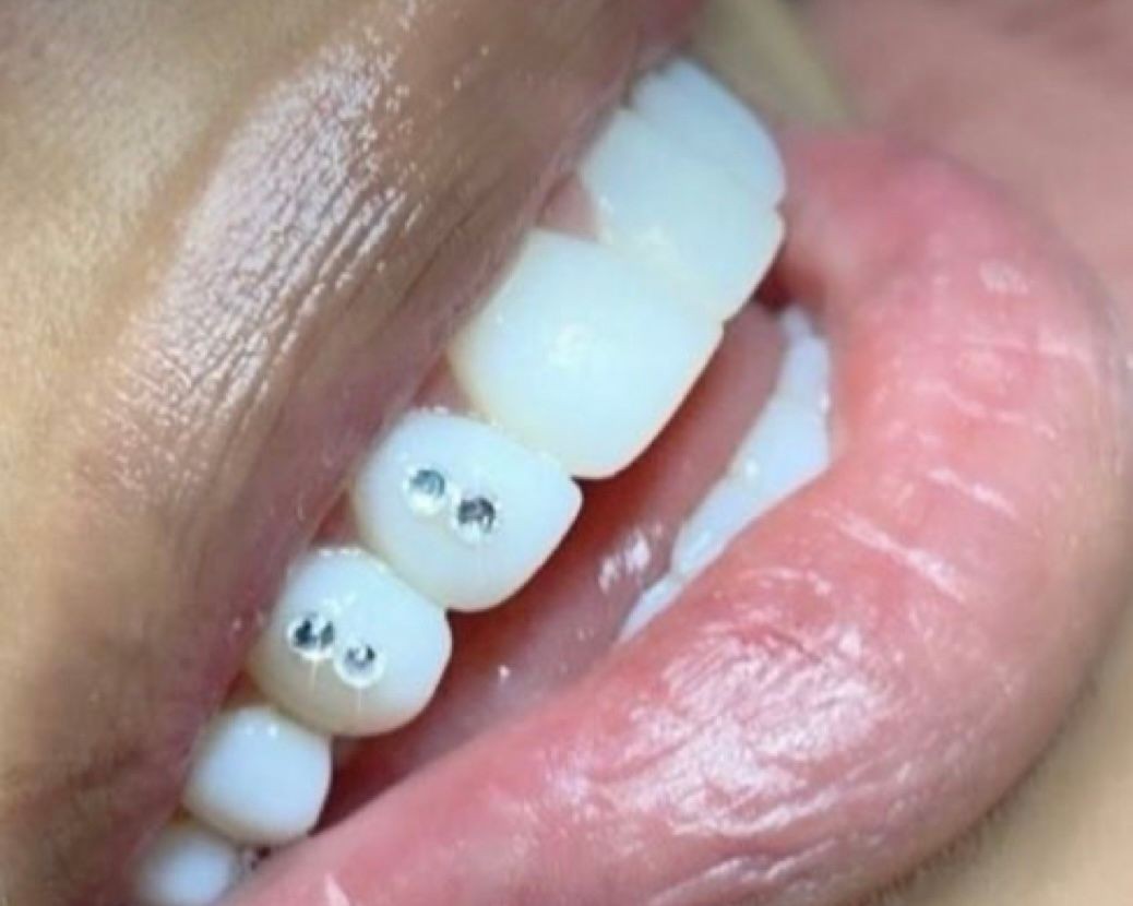 Tooth Gems 